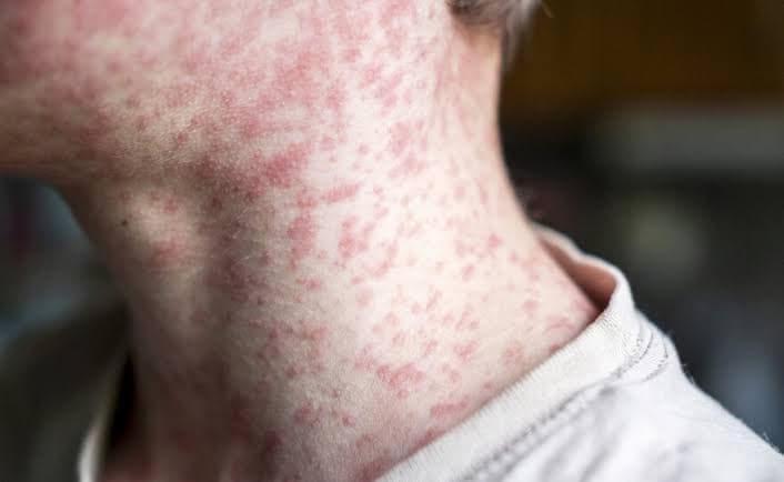 13 New Measles Cases Reported in Malé, National Total Reaches 199